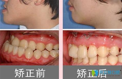 地包天牙齒|地包天的原因是什麼？我們又該如何有效矯正？